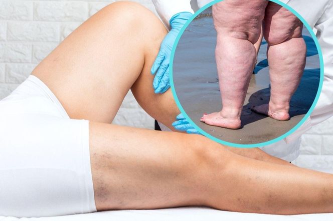 Lipoedema – mało znany duży problem. Czym jest „choroba grubych nóg”