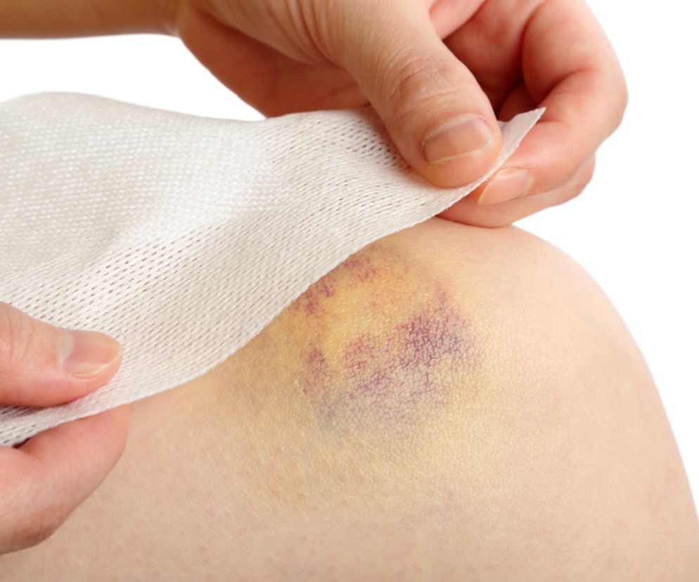 Zimny okład z wody i octu złagodzi obrzęk po stłuczeniu.