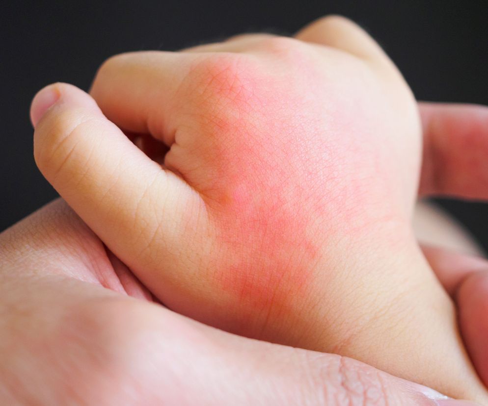 Rumień czyli zmiany rumieniowe na skórze mogą występować w przebiegu wielu chorób o różnych podłożach.