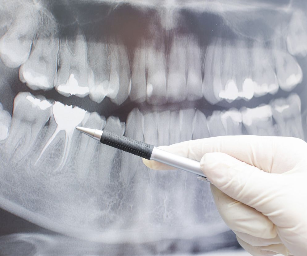 Rentgen (RTG) zębów - badanie radiologiczne zębów