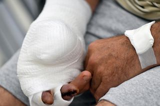 W 5 Klinicznym Szpitalu Wojskowym  Krakowie przyszyli panu Markowi kciuk