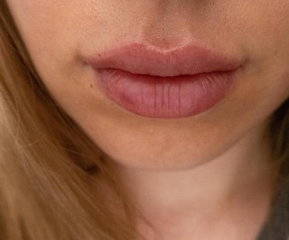 Co się dzieje z wypełniaczami pod skórą? Chirurg pokazał nagranie