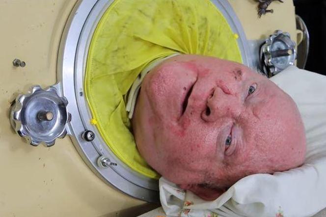 Paul Alexander nie żyje. Spędził 70 lat w sarkofagu dla chorych na polio