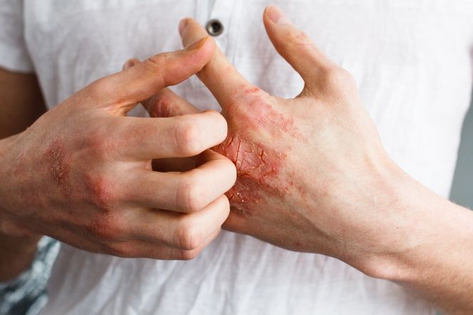 Choroba skóry AZS