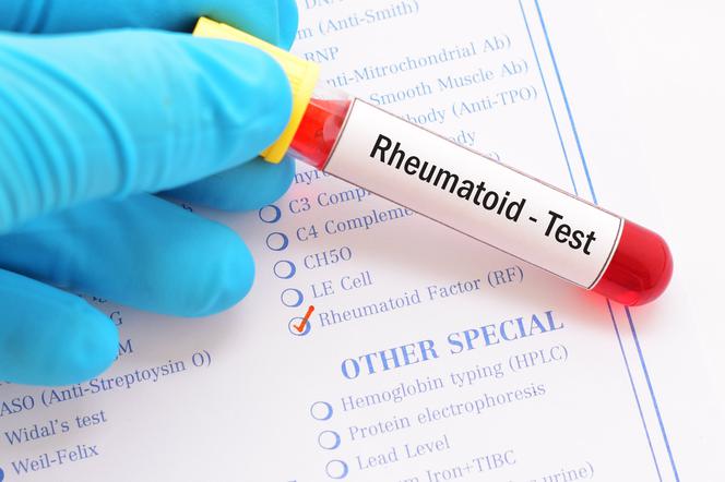 RF czyli czynnik reumatoidalny – definicja, wykrywanie i znaczenie w patologii