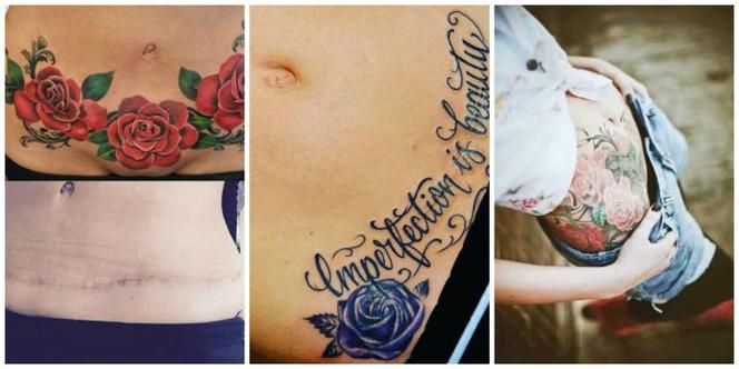 Kobiety robią sobie tatuaże na bliznach po cesarskim cięciu. Dobry pomysł?