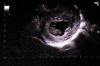 USG w 9. tygodniu ciąży
