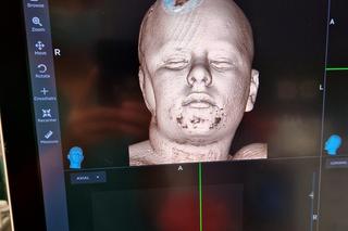 Niezwykłe osiągnięcie lekarzy z Warszawy. Usunęli z głowy Natanka guza mózgu