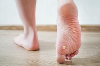 Odciski na stopach - jak im zapobiegać i jak pozbyć się odcisków?