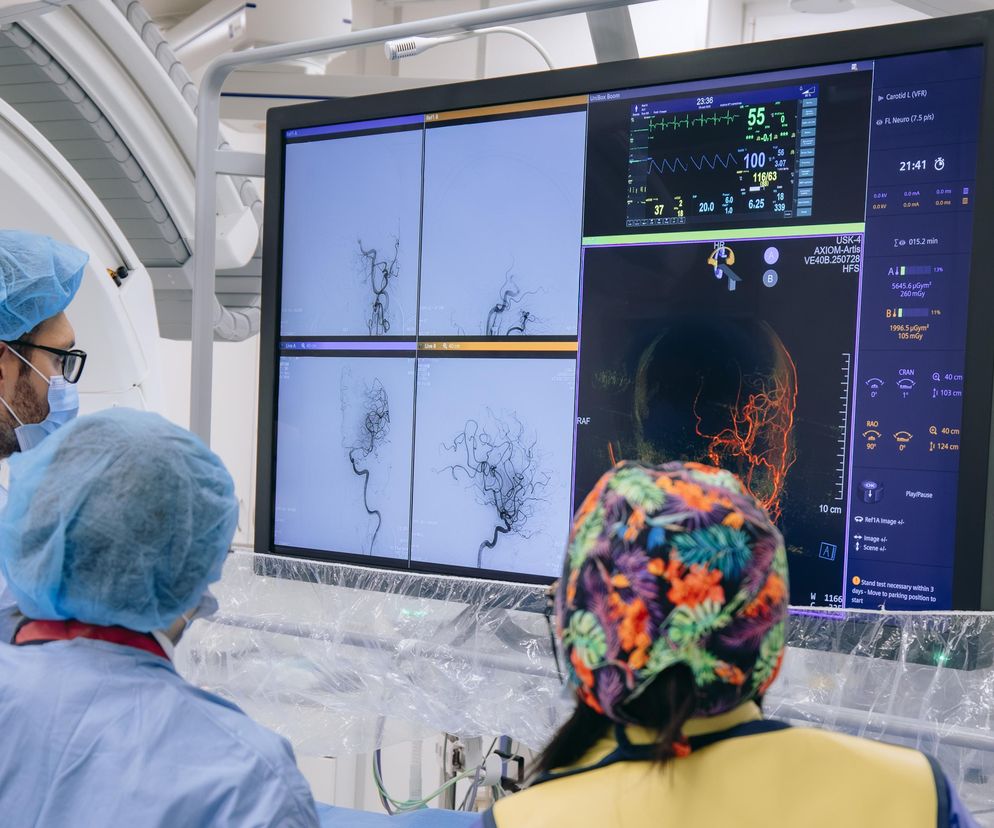 Pojawia się nagle i dotyka coraz częściej młode osoby. Jakie są objawy udaru mózgu?