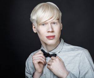 Albinizm (bielactwo wrodzone) - rodzaje, przyczyny, objawy. Czy albinizm można wyleczyć?