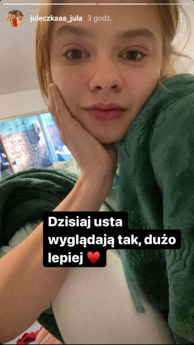 Julia Wróblewska po zabiegu powiększenia ust