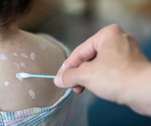 Czy na ospę można zachorować drugi raz? „To nie jest tylko czarne lub białe”