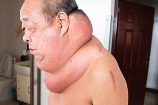 Mężczyzna z wielką szyją