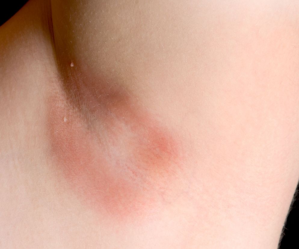 Wyprzenie to problem dermatologiczny polegający na tworzeniu się stanów zapalnych w pocierających o siebie fałdach skórnych.