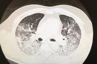 Lekarz pokazał tomografię płuc 44-latka z COVID. Koszmarny widok [WIDEO]
