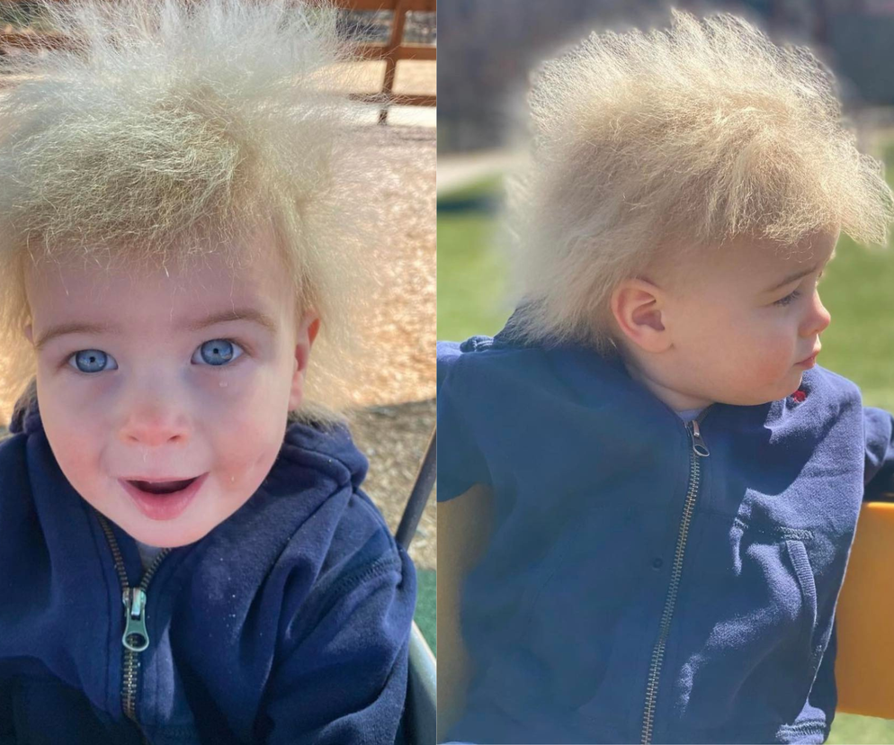 Chłopiec z syndromem nieuczesanych włosów