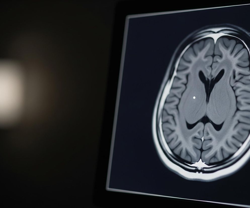 Ekran monitora wyświetla obraz tomografii komputerowej ludzkiego mózgu, widziany od góry, zajmując prawą część kadru. Na czarnym tle monitora, okrągły kształt mózgu ukazuje szare i białe obszary, z wyraźnie zarysowanymi bruzdami i zwojami. W centrum obrazu mózgu widoczna jest biała, świecąca kropka. Lewa strona zdjęcia jest rozmyta i ciemna, z jaśniejszym, rozproszonym światłem w centrum lewej strony.