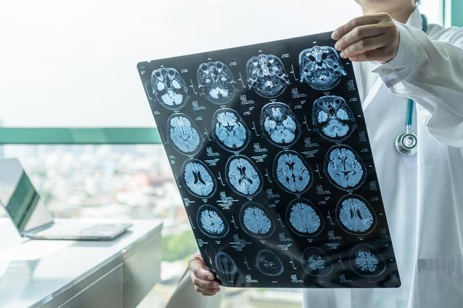 Wykryj Alzheimera zanim pojawią się objawy. Wszystko dzięki tej wskazówce