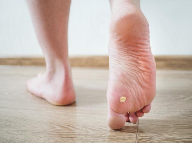 Odciski na stopach - jak im zapobiegać i 