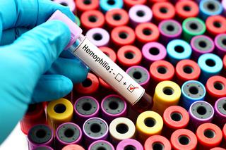Hemofilia - na czym polega ta choroba genetyczna?