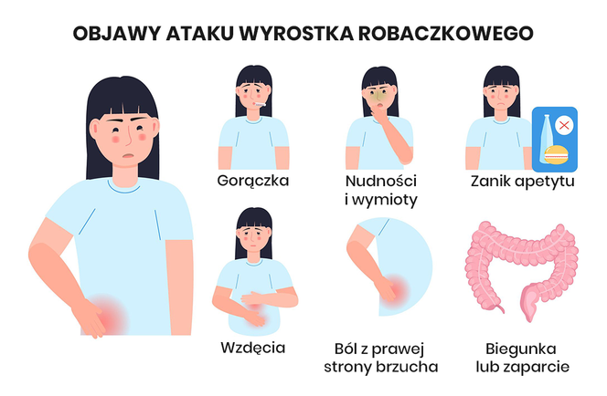 Objawy ataku wyrostka robaczkowego