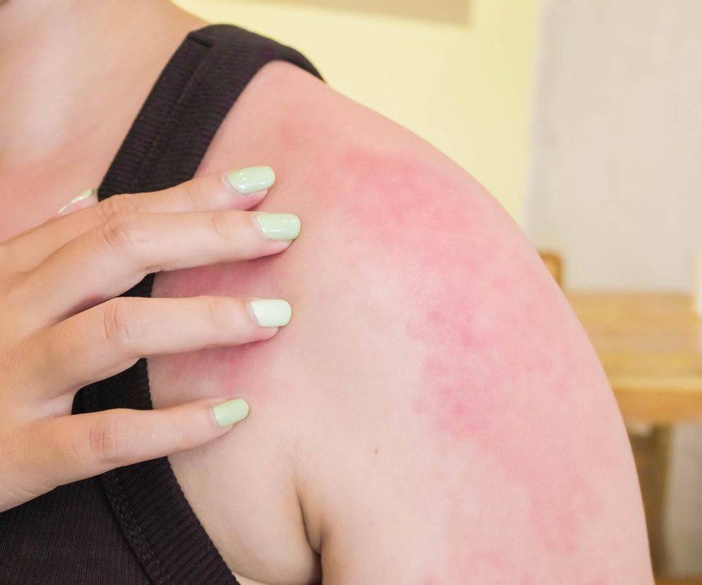 Alergia na wodę? “Potworne uczucie pieczenia głęboko pod skórą”