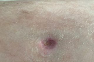 USK we Wrocławiu stawia na skuteczną terapię ran u dzieci