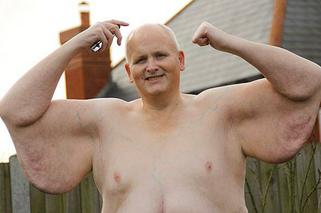 Najgrubszy człowiek świata schudł 300 kilogramów 