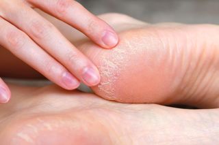 Pękające pięty to nie tylko problem estetyczny. Kiedy stają się sygnałem ostrzegawczym?