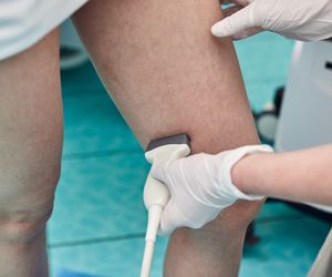 Źle leczone zakrzepowe zapalenie żył powierzchownych może być groźne