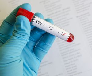 Wirus Epsteina-Barr (EBV) może być przyczyną raka. Co to jest wirus EBV?