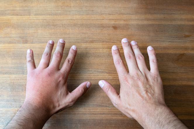 Ból lewej ręki - przyczyny. Dlaczego ręka boli?