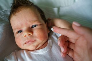 Potówki, alergia czy groźna infekcja? Jedna cecha wysypki powinna od razu zaniepokoić rodzica