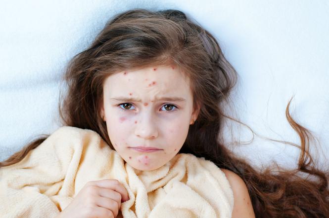 Wzrost zachorowań w Polsce na ospę wietrzną  o blisko 25%