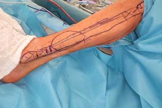 Z kości strzałkowej odtworzono żuchwę. Szpital w Zielonej górze mówi o unikalnej operacji [ZDJĘCIA]