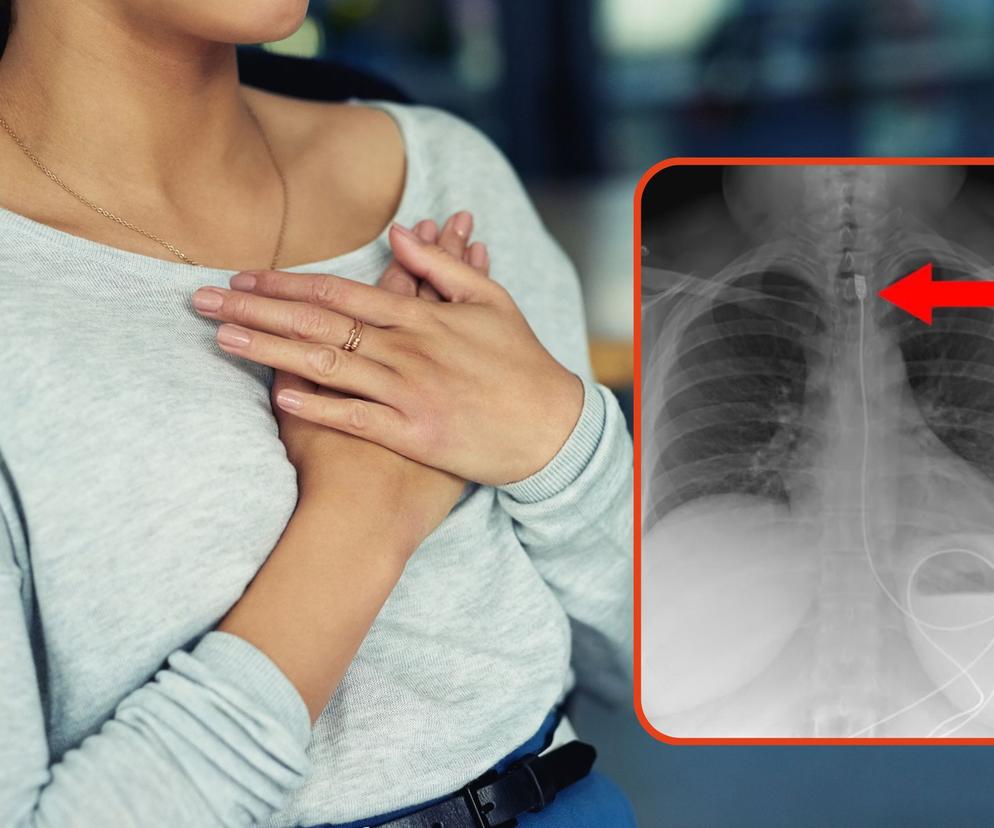 Trafiła na SOR z metrowym kablem w przełyku. Lekarze zdiagnozowali rzadkie zaburzenie