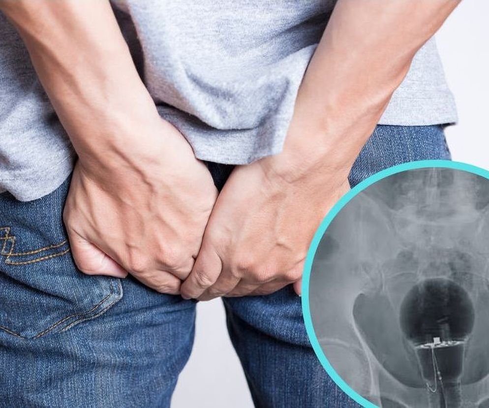 Trudno uwierzyć, co miał w odbycie. Jak twierdził, tym leczył zaparcia