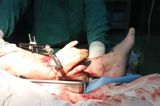 Chińscy lekarze wszyli pacjentowi dłoń w nogę