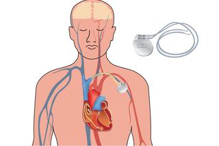 Kardiowerter-defibrylator (ICD) - co to jest? Jak działa?