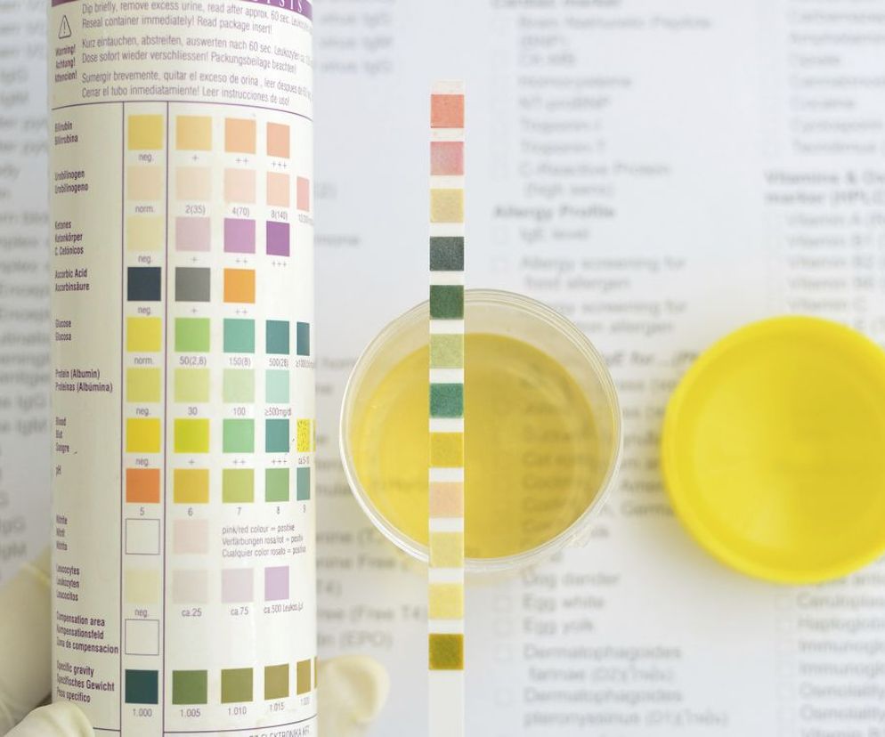 Zespół nerczycowy  to grupa objawów, które pojawiają się, gdy dojdzie do uszkodzenia kłębuszków nerkowych.