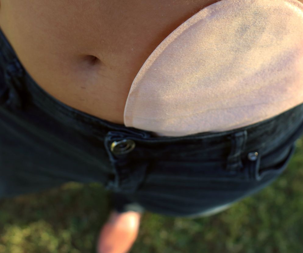 zbliżenie na stomię