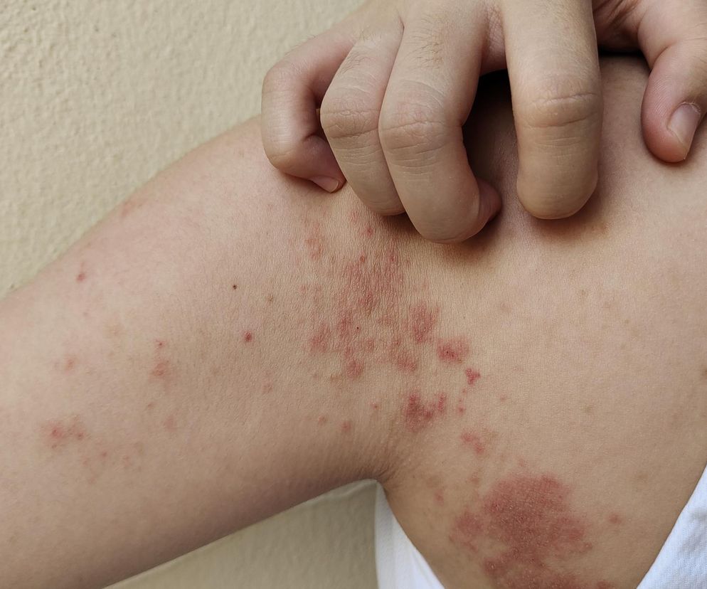 Ugryzienia owadów i pajęczaków: Jak je rozpoznać i co z nimi zrobić?