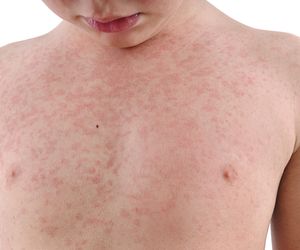 Alergia kontaktowa u dzieci: przyczyny, objawy, leczenie