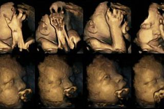 Szokujące zdjęcia dziecka rozwijającego się w łonie palaczki! Czym różni się od zdrowego dziecka?   