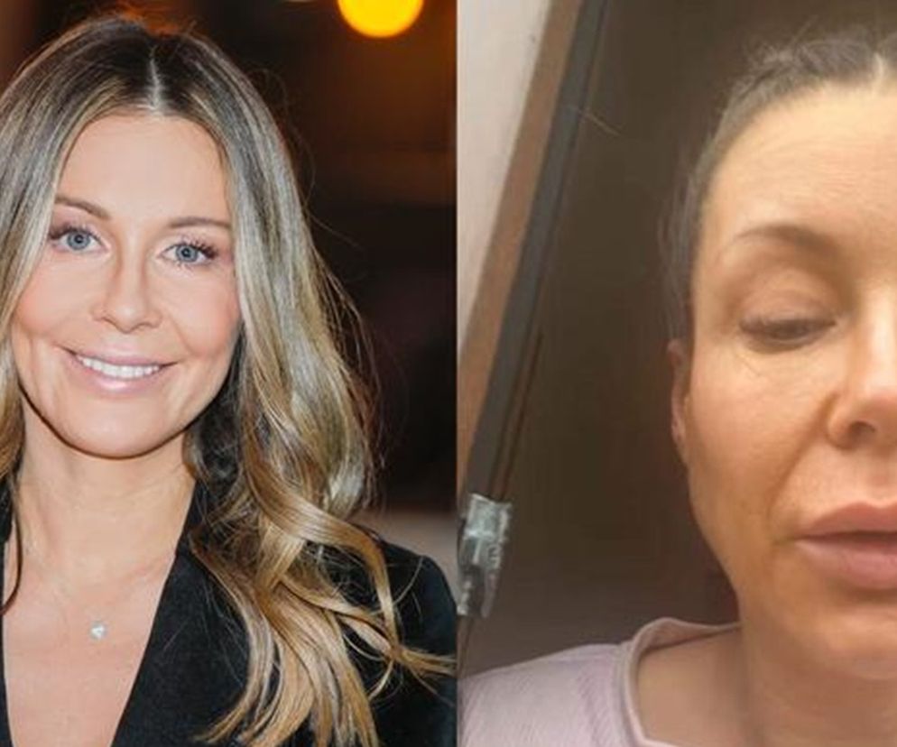 Co się stało z twarzą Rozenek?