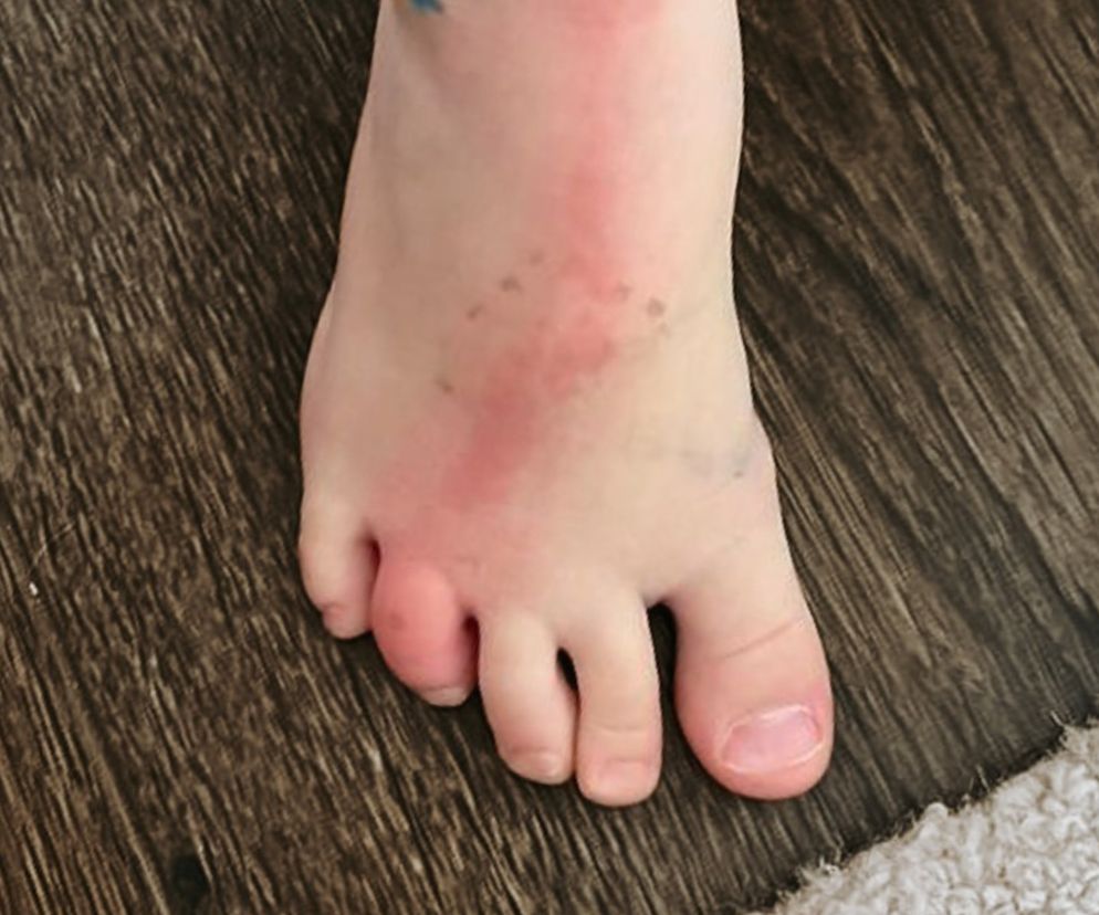 Widzisz taki ślad na skórze? Jest objawe groźnej dolegliwości