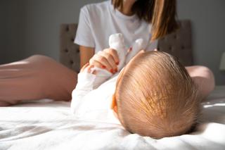 Ciemieniucha - jak walczyć z żółtymi łuskami na głowie niemowlęcia?