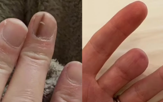 Smuga na paznokciu i zdjęcie po amputacji części palca