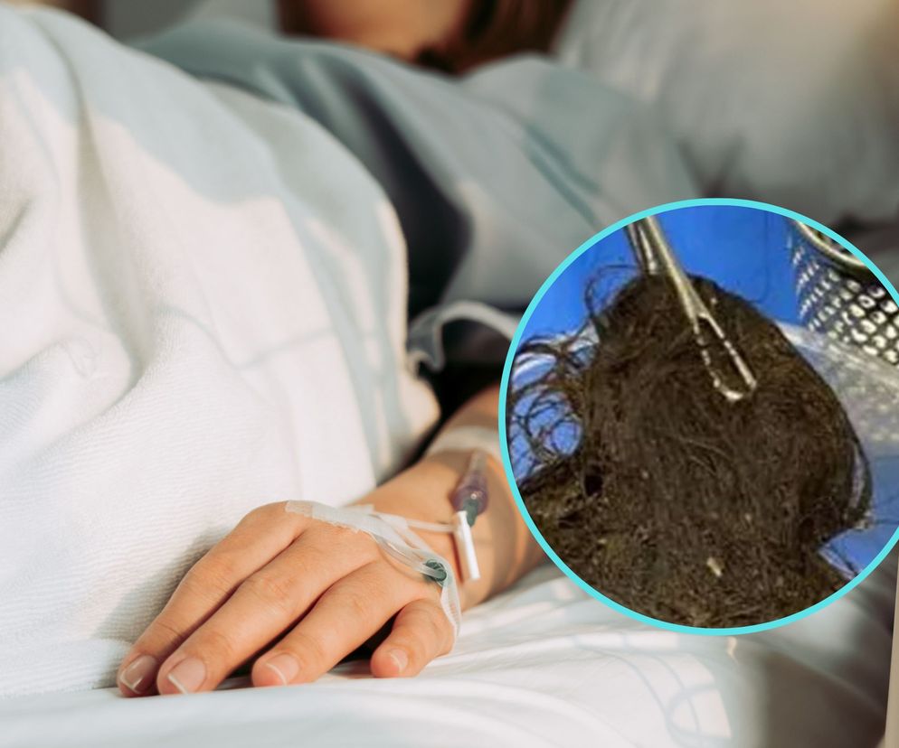 To wyjęli z żołądka 17-latki. Okazało się, że cierpi na zespół Roszpunki 